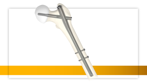 Stryker's Gamma4 System is indicated for the treatment of stable and unstable fractures, as well as for stabilization of bones and correction of bone deformities in the intracapsular, trochanteric, subtrochanteric and shaft regions of the femur (including osteoporotic and osteopenic bone). (Photo: Business Wire)