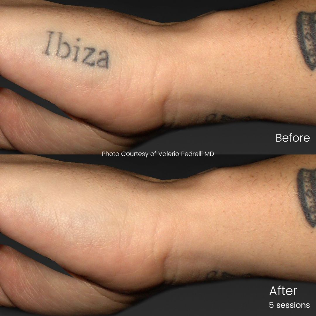 Big Questions On Tattoo Removal Laser Tech Added | Tattoo Removal Institute