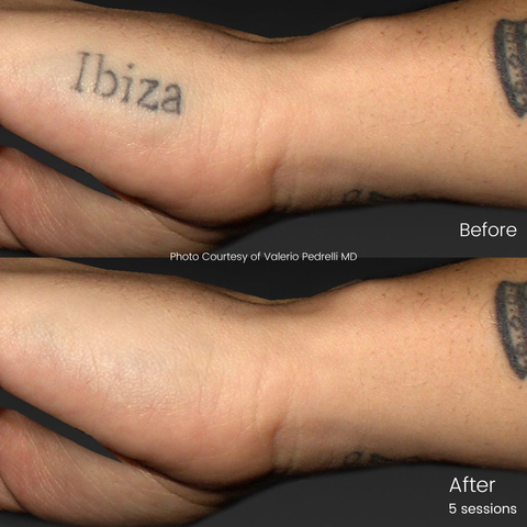 Trattamento Pico Tune-Ink - rimozione tatuaggio (Photo: Business Wire)