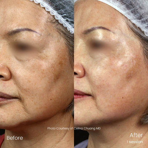 Tratamiento Pico Filling – rejuvenecimiento de la piel (Foto: Business Wire)
