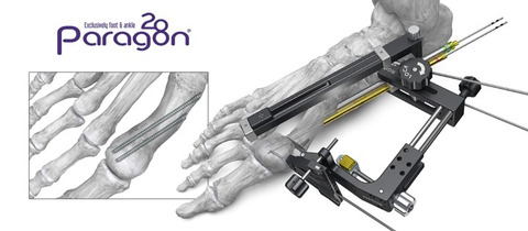 Figure 1: PRECISION® MIS Bunion System (Graphic: Business Wire)