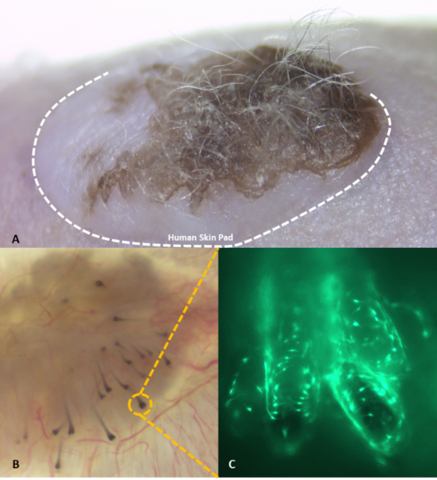 A. Hair-bearing human skin xenograft on immunocompromised nude mouse 10 weeks after transplant of Stemson engineered follicular units (EFU). B. Underside image of excised human skin xenograft showing hair bulbs generated by Stemson EFUs. C. Enlarged image of hair bulb demonstrating green fluorescent protein (GFP) labelled cells from Stemson EFUs are responsible for generating human hair follicles in skin pad. (Photo: Business Wire)