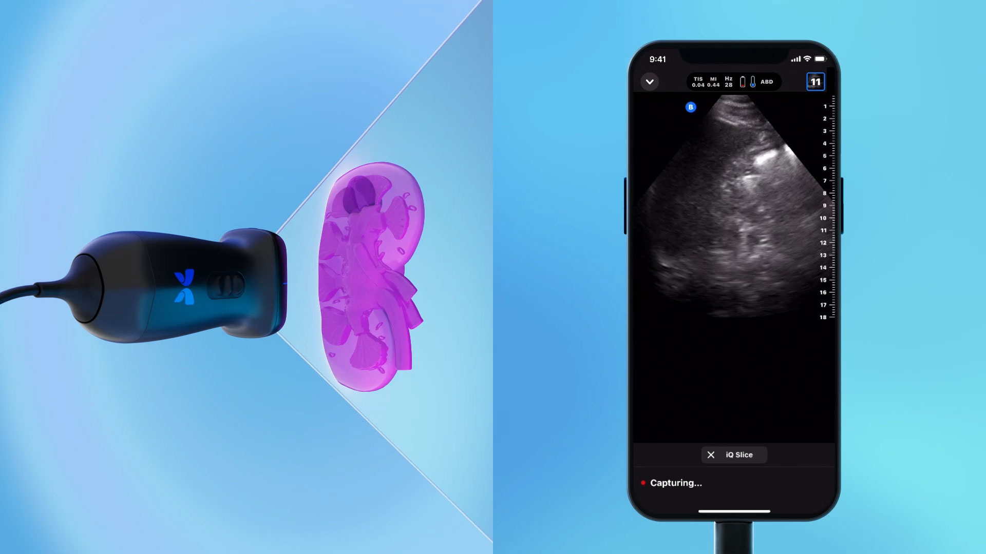 An animation demonstrating Butterfly iQ Slice™: The world’s first automated, sequential ultrasound capture mode on a handheld device.