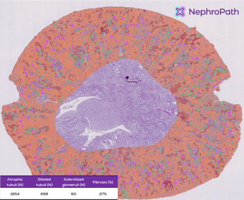 thumbnail Figure 1. Illustration of the NephroPath platform’s capabilities in performing automated quantification and multi-class prediction on an entire rat kidney cortex. Notable classes: normal tubuli (orange), atrophic/dilated tubuli (green/red), glomeruli (pink), abnormal/sclerotic glomeruli (dark blue), arteries (light blue), interstitium (not colored). (Photo: Business Wire)