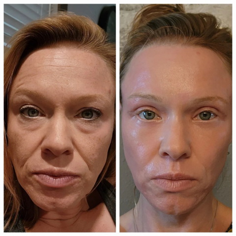 original New procedure sets back the skin’s clock and restores the upper eyelid to younger, tighter-looking skin. (Photo: Business Wire)