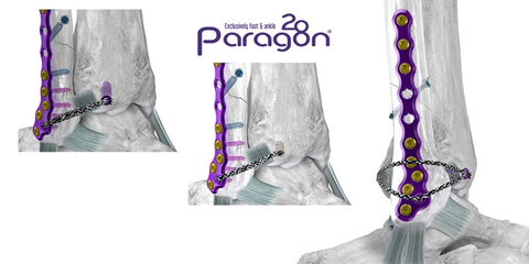 Figure 1: Anterior inferior tibiofibular ligament (“AITFL”) Repair Showing the Grappler® R3INFORCE™ Dynamic Anchor (left) and Grappler® Knotless Anchor (center). Complete Extraosseous Repair with Grappler® R3INFORCE™ System shown on right. (Graphic: Business Wire)