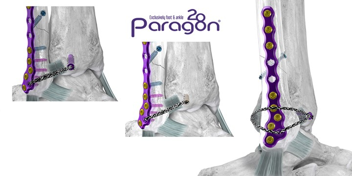 Paragon 28 Adds to Suite of Novel Syndesmosis Repair Solutions 