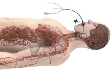 About Attune Medical® and ensoETM®: Attune Medical, now a part of Haemonetics, is the pioneer of the ensoETM, a single use thermal regulating device that is placed in the esophagus (similar to a standard orogastric tube) and connected to an external heat exchange unit, creating a closed-loop system for proactive controlled temperature management and reduction of the likelihood of ablation-related esophageal injury resulting from radiofrequency cardiac ablation procedures. (Graphic: Business Wire)