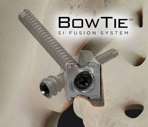 BowTie SI Fusion System with Integrated Iliac and Transfixation Screws (Photo: Business Wire)