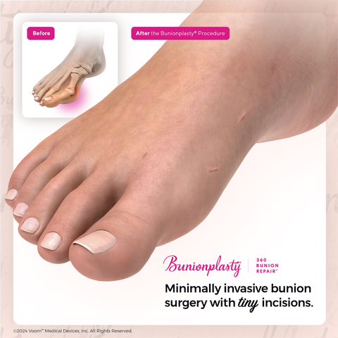 The Bunionplasty® 360 Bunion Repair™ is performed through tiny laparoscopy-like incisions rather than long Frankenstonian incisional approaches seen with outdated 3D or 4D repairs. (Photo: Business Wire)