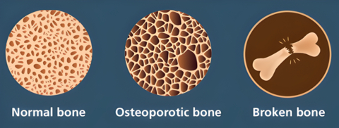 Preventing fractures through bone health (Graphic: Business Wire)