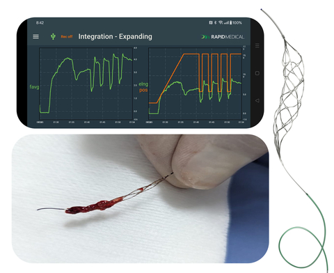 The AI-powered TIGERTRIEVER removes stroke-causing blood clots during first-in-man procedures in Colombia. Rapid Medical’s portfolio of active technology allows greater procedural personalization, which is enhanced with AI workflow. (Photo: Business Wire)