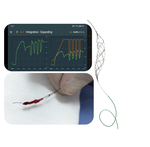 The AI-powered TIGERTRIEVER removes stroke-causing blood clots during first-in-man procedures in Colombia. Rapid Medical’s portfolio of active technology allows greater procedural personalization, which is enhanced with AI workflow. (Photo: Business Wire)