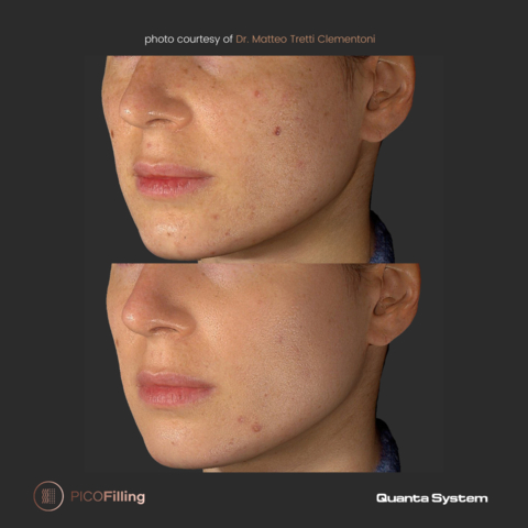 Dr. Matteo Tretti Clementoni - Pico Filling Treatment - Before & After (Photo: Business Wire)