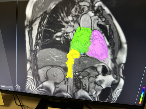 thumbnail Imricor’s NorthStar Mapping System being used in the VISABL-AFL Procedure (Photo: Business Wire)