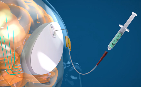 CraniUS™’s Disruptive Innovation: The world’s first smart, refillable, and fully implantable medical device for direct medicine delivery to the brain. (Graphic: Business Wire)