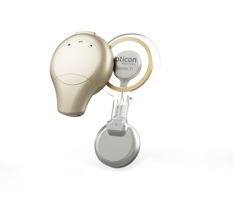 thumbnail The Sentio System includes an external Sentio 1 Mini sound processor and a Sentio Ti Implant placed under the skin. (Photo: Business Wire)