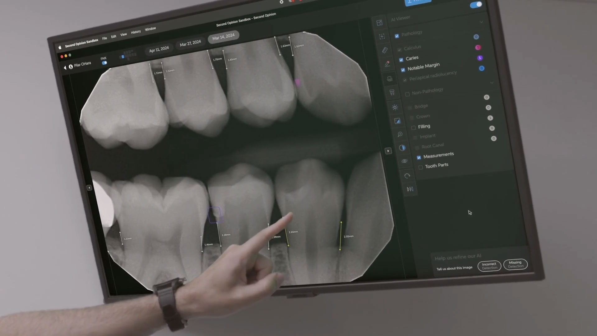 全球首屈一指的牙科人工智慧公司Pearl今天宣布，該公司已獲得5800萬美元的B輪融資，以加快推進其提升牙科病患護理水準的使命。
