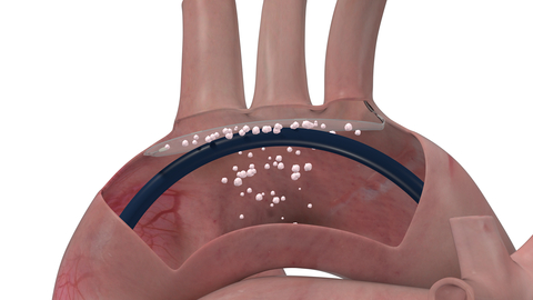 The ProtEmbo Cerebral Embolic Protection system in the Aortic Arch  (Graphic: Business Wire)