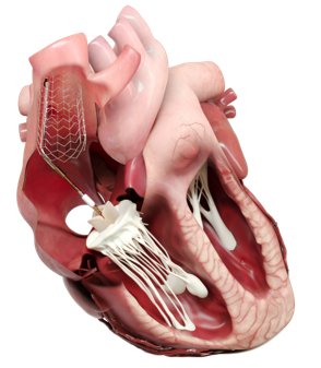 CroíValve's DUO™ Tricuspid Coaptation Valve System (Graphic: Business Wire)