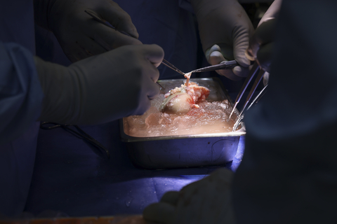 Surgeons prepare the eGenesis porcine kidney for transplantation. (Photo credit: Massachusetts General Hospital)