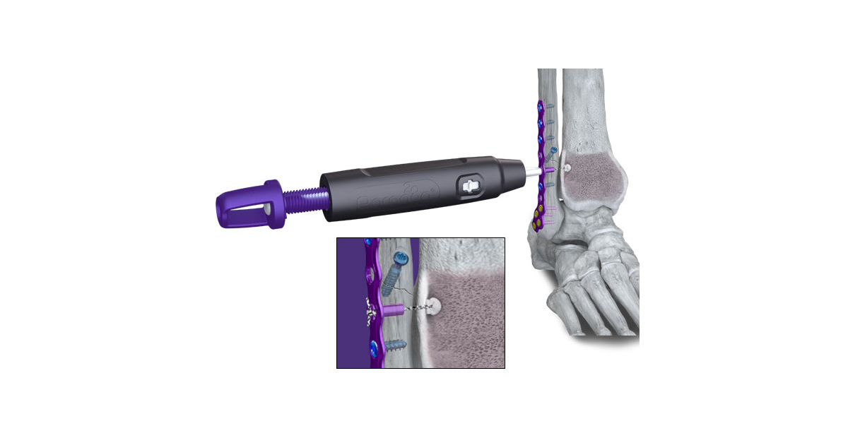 Paragon 28 Launches the R3FLEX™ Stabilization System to Anatomically