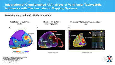 Vektor Medical HRX Study Presentation Highlights | Two studies showcase how Vektor’s advanced technologies uniquely leverage AI and deep learning to assess wall thickness and scar tissue in ventricular tachycardia (VT) patients, providing crucial insights for electrophysiologists performing ablation procedures.