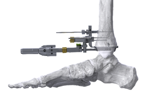 Figure 1: Image of the APEX 3D Right-Angle Drill being used in surgery to prepare the tibia for the APEX 3D implant. (Graphic: Business Wire)