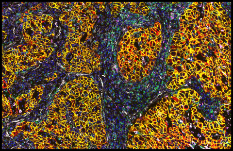 Human lung cancer specimen demonstrating tumor and immune interactions with a subset of Noetik protein panel (Photo: Business Wire)