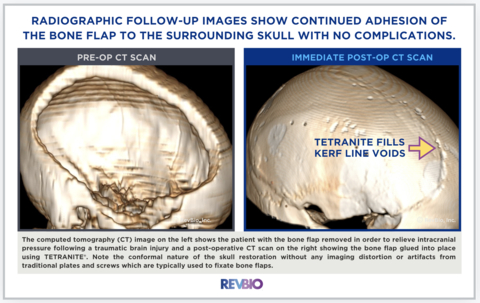 The computed tomography (CT) image on the left shows the patient with the bone flap removed to relieve intracranial pressure following a traumatic brain injury and a post-operative CT scan on the right showing the bone flap glued into place using TETRANITE. Note the conformal nature of the skull restoration without any imaging distortion or artifacts from traditional plates and screws which are typically used to fixate bone flaps. (Photo: Business Wire)