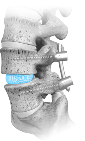 The only conforming, patient specific expandable implant on the market, OptiMesh is delivered through one of the smallest insertion profiles, dynamically conforms to a patient’s unique endplate morphology, and powerfully expands to one of the largest implant footprints available. (Photo: Business Wire)