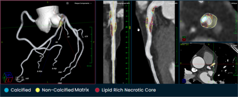 The Elucid PlaqueIQ™ user interface is a fully interactive visualization of the patient’s coronary anatomy, showing specific plaque type and amount across various views to inform physician assessment of risk and patient-specific treatment pathway. The original CT image is preserved to provide further context. (Photo: Business Wire)