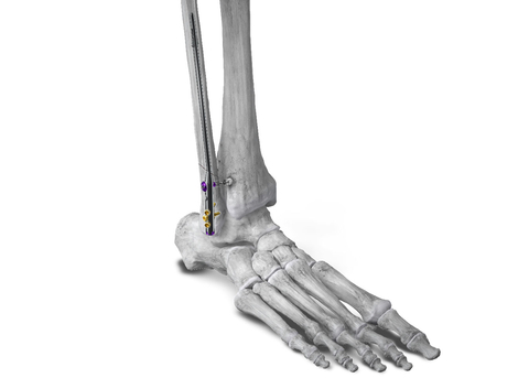 Figure 1: Phantom® Fibula Nail implanted in the fibula for fracture stabilization with syndesmotic repair using the R3FLEX™ Stabilization System (Photo: Business Wire)