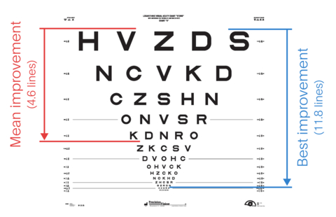 Example improvements in visual acuity on a logMAR chart (Graphic: Business Wire)