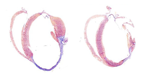 Cardiac damage in a mouse after myocardial infarct (left image; thinned purple portion on the lower part of the heart) and how the YAP activator drug being developed at Scripps Research stimulates the tissue to repair itself by expanding endogenous cardiomyocytes, the resident muscle cells of the heart (right image; thicker pink area in the same area of the right image). Image credit: Scripps Research