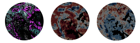 Example results from a cell teleporting experiment. Here, we take a ”virtual CD8 T cell” expressing only CD3 and CD8 and teleport it to see what its predicted gene expression will be in the context of each tumor and TME neighborhood in the tissue. (Graphic: Business Wire)