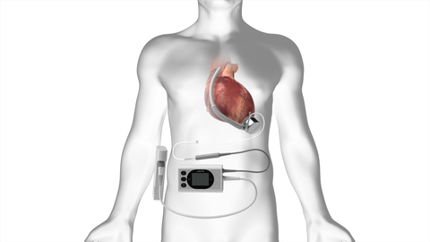 The BrioVAD® System features the innovative BrioVAD Pump, a fully magnetically suspended blood pump, paired with uniquely engineered external components aimed at reducing adverse events and enhancing patients' quality of life. (Graphic: Business Wire)