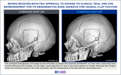 The computed tomography (CT) image on the left shows a patient who received TETRANITE® to fixate their cranial flap three months following brain surgery. On the right, a post-operative CT scan of the same patient six months following their surgery shows the conformal nature of the skull restoration and the reintegration of the flap with the surrounding bone. (Photo: Business Wire)