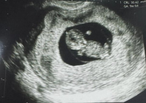 Photo caption: Ultrasound image of baby. Photo credit: Gameto.