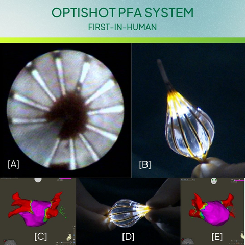 Image: [A] Endoscopic view of LSPV, [B]&[D] OptiShot Balloon, [C]&[E] Post PFA map (Photo: Business Wire)