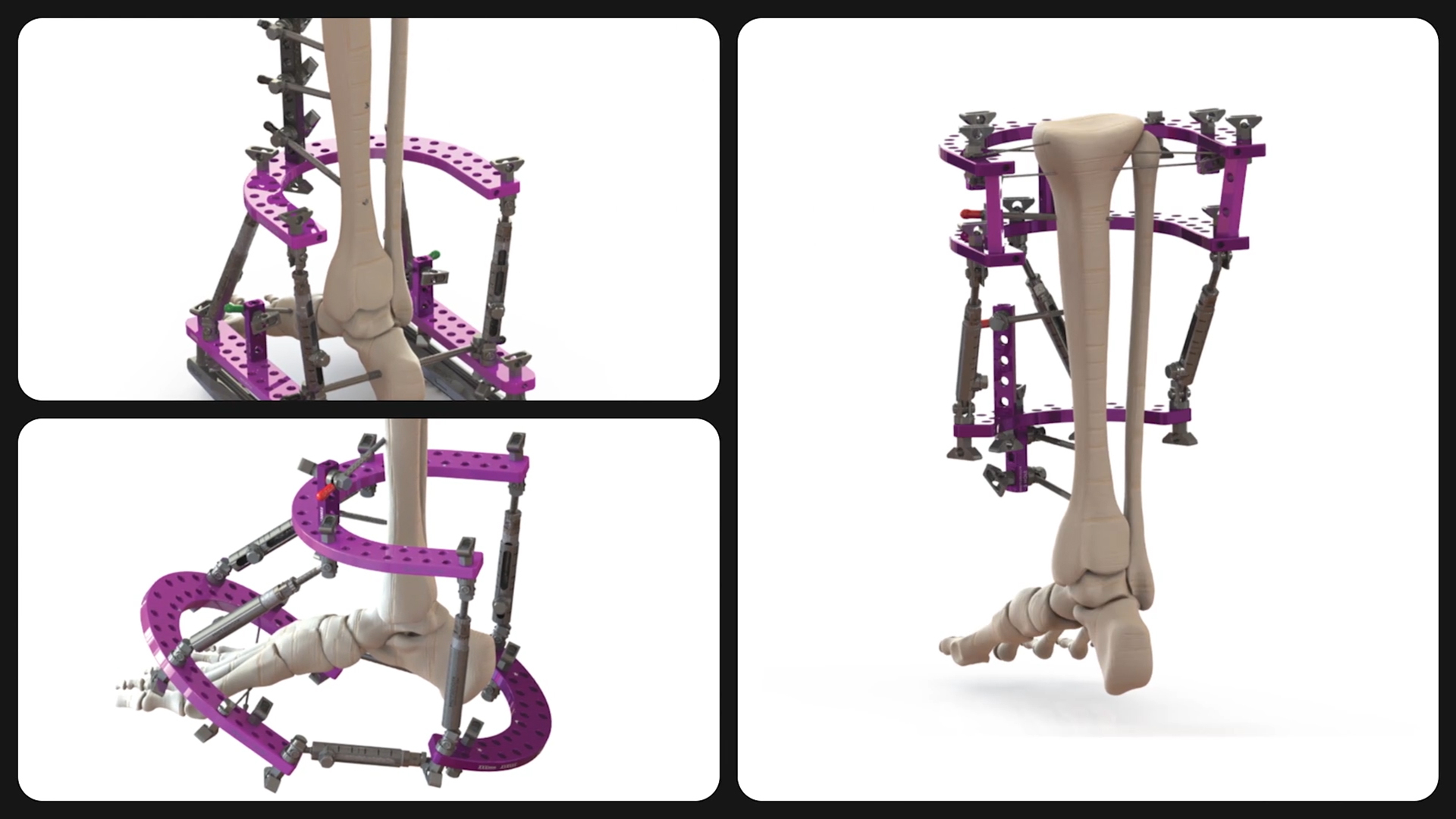 Strategic Expansion Extends Fusion Orthopedics' Reach in Foot & Ankle​