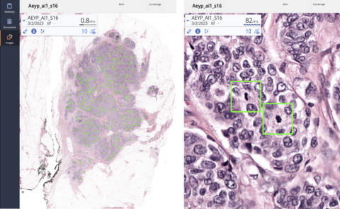 Figure 1. Mitotic figures detected and highlighted in a whole slide image of breast biopsy by Aiosyn Mitosis Breast. (Graphic: Business Wire)