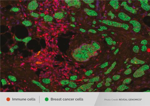 Microscopic image of tissue showing breast cancer cells in green and CD45-positive immune cells in red, highlighting their interaction in the tumor microenvironment. (Photo: Business Wire)