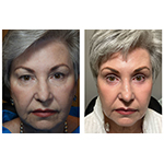The_Better_Blepharoplasty_Adam_Scheiner_MD.jpg