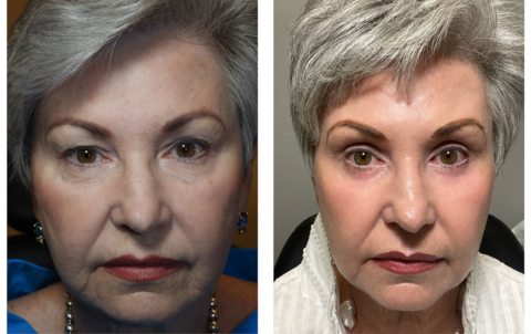 original A patient who underwent Dr. Adam Scheiner’s laser eyelid and facial rejuvenation shows dramatic improvement.