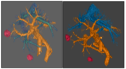 original Dr. Mustafa Raoof and team tested an innovative approach on two patients whose pancreatic tumors had resisted earlier treatments. The patients experienced up to a 49% shrinkage in their liver metastases after taking the City of Hope-developed experimental AOH1996 pill twice a day for two months. Overall, the experimental approach was most effective at killing cancer cells with high replication stress. (Photo Credit: Dr. Mustafa Raoof / City of Hope)