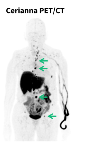 original PET/CT scan with Cerianna™ (fluoroestradiol F18) injection for patient with ILC reveals bone metastases