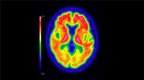 original PET brain scan using Vizamyl (flutemetamol F18) with quantification software