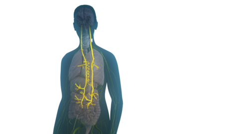 original The SetPoint System by SetPoint Medical is Implanted on the Vagus Nerve