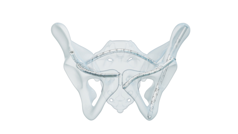 original The next-generation CurvaFix® Low Profile System received FDA clearance for the fixation of pelvic fractures. The percutaneous solution is an essential tool in the pelvic fixation armamentarium for pathological bone, curved corridors, intersecting fixation pathways, and indwelling and adjacent hardware indications.
